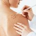 Mole Removal Non-Invasive Treatment Options